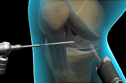 knee arthroscopy illustration